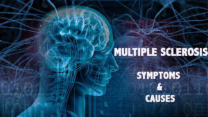 Multiple sclerosis - Symptoms and Causes | Psyspeaks