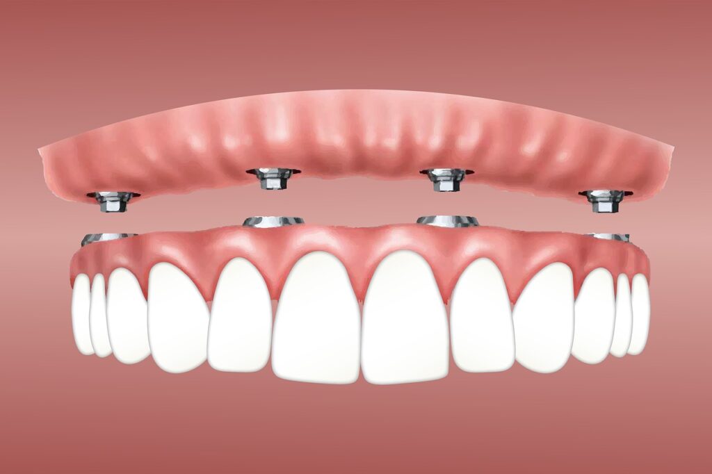 what-are-dental-implants-benefits-of-dental-implants