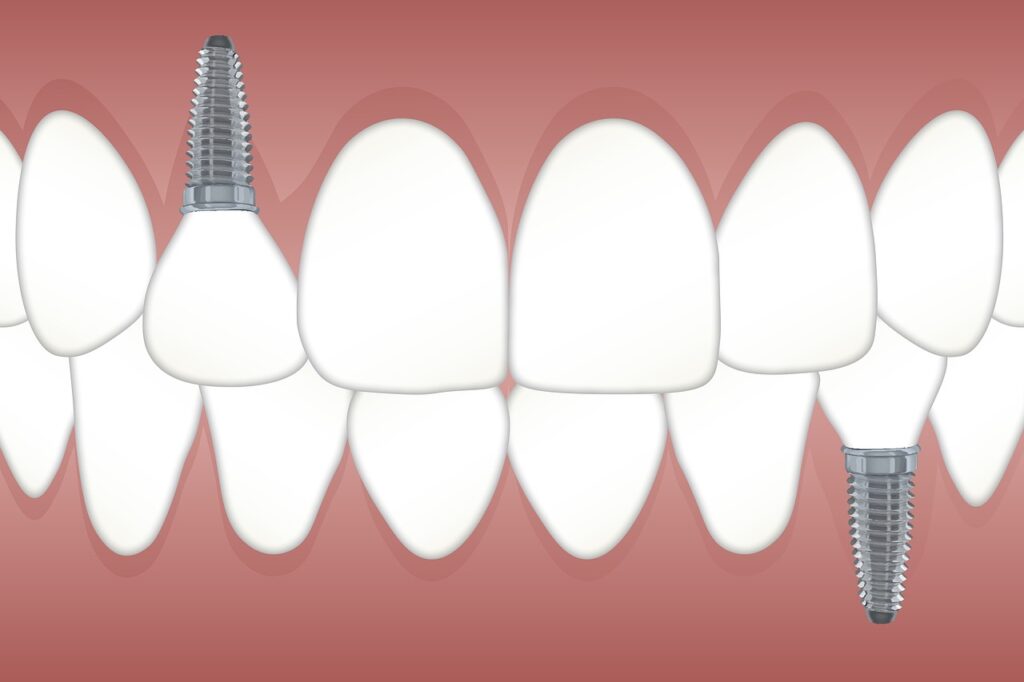 what-are-dental-implants-benefits-of-dental-implants