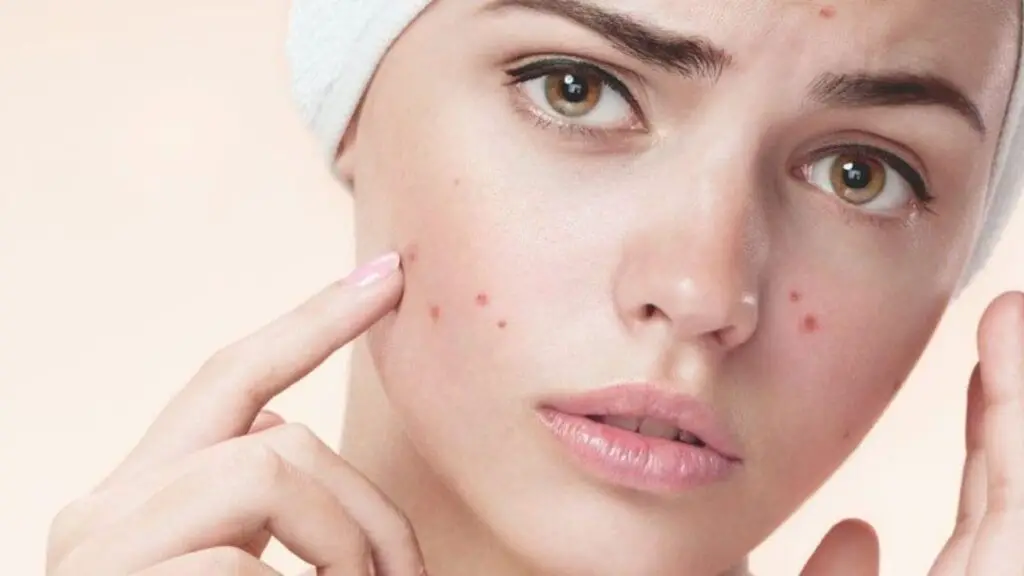 What-causes-acne-on-face?-Foods-to-avoid-pimples-on-the-face